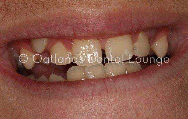 Before - Oatlands Dental Lounge