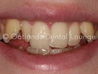 Before - Oatlands Dental Lounge