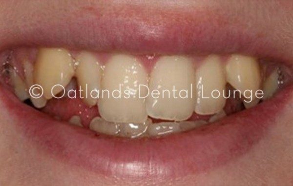 Before - Oatlands Dental Lounge