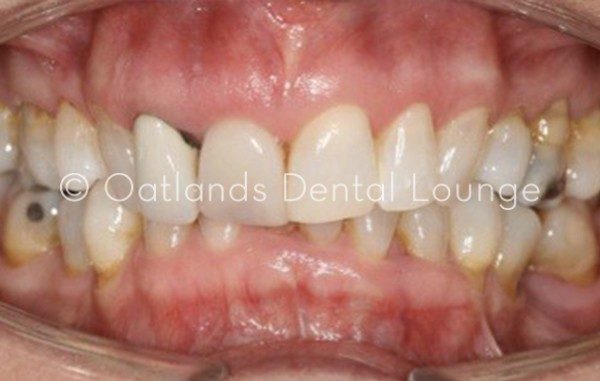 Before - Oatlands Dental Lounge