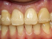 Before - Oatlands Dental Lounge