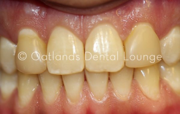 Before - Oatlands Dental Lounge