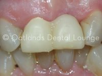 Before - Oatlands Dental Lounge