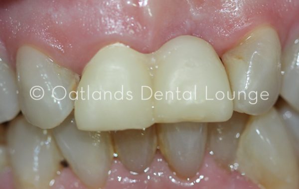 Before - Oatlands Dental Lounge