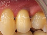 After - Oatlands Dental Lounge
