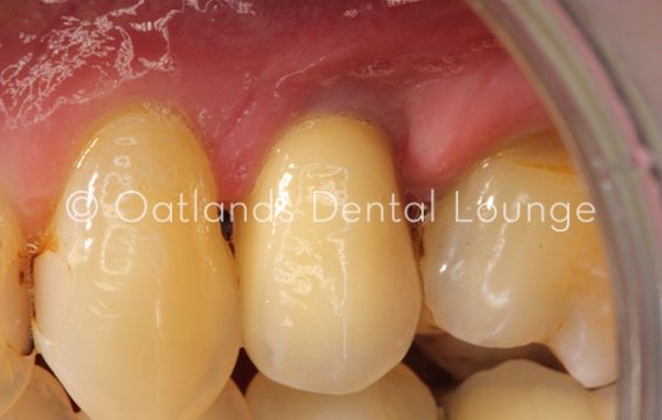 After - Oatlands Dental Lounge