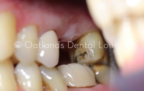 Before - Oatlands Dental Lounge