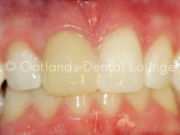 Before - Oatlands Dental Lounge