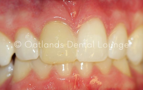 Before - Oatlands Dental Lounge