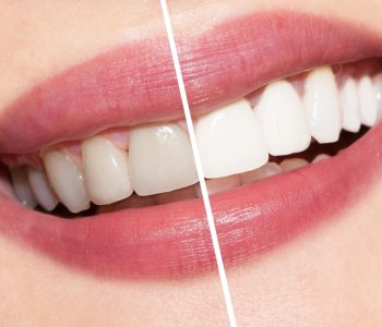 Blog - Oatlands Dental Lounge